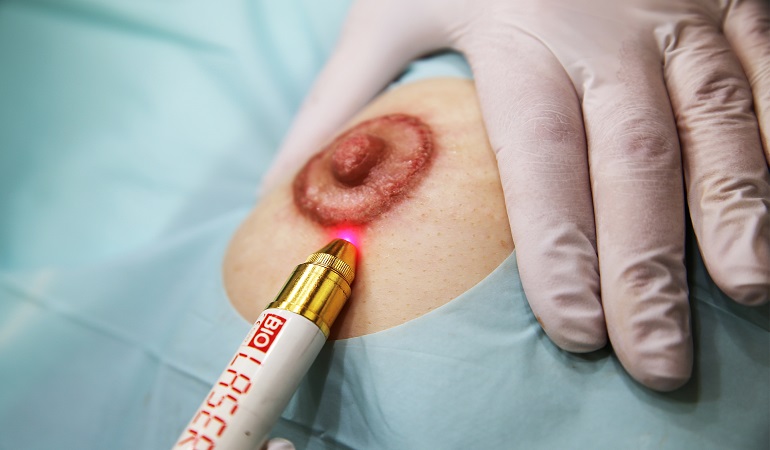 areola micropigmentation medizinkosmetik berlin 770x450 areola micropigmentation medizinkosmetik berlin 770x450