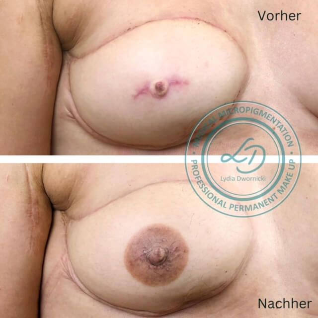 Areola Pigmentierung nach Brustaufbau