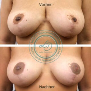 Brustwarzenkorrektur-medizinische-pigmentierung-lydia-dwornicki-medizinkosmetik-berlin Narbenpigmentierung zur Brustwarzenkorrektur von Lydia Dwornicki