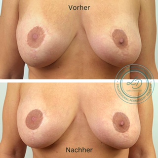 Brustwarzenkorrektur mit medizinischer Pigmentierung - Medizinkosmetik Berlin Brustwarzenkorrektur mit medizinischer Pigmentierung von Medizinkosmetik Berlin