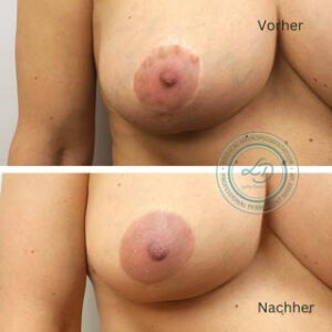 Narbenkorrektur-areola-medizinische-pigmentierung-lydia-dwornicki Narbenkorrektur des Warzenhofes mit medizinischer Pigmentierung von Lydia Dwornicki